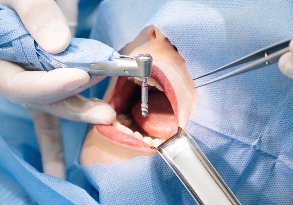 Close-up shot of attentive doctors performing surgical operation installing dental implants into patient’s mouth in modern dental clinic. Dental instruments. Stomatology clinic. Dental surgery Close-up shot of attentive doctors performing surgical operation installing dental implants into patient's mouth in modern dental clinic. Dental instruments. Stomatology clinic. Dental surgery.